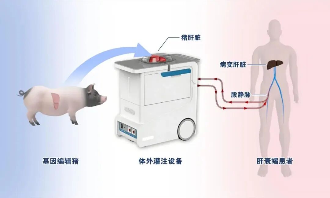 国际首例!中科奥格6基因编辑猪肝脏体外灌注治疗肝衰竭患者获成功